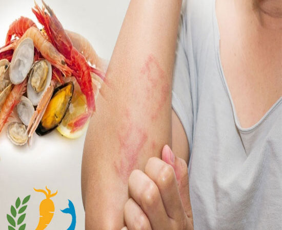 Symptoms Of Food Allergy
