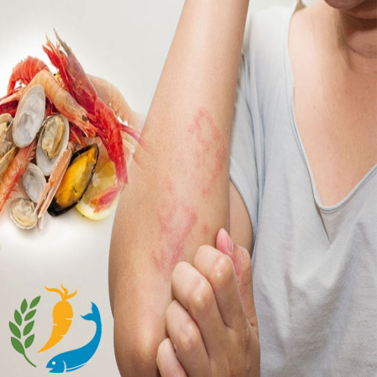 Symptoms Of Food Allergy 